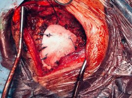 SU-POR-BRAİN SURGERRY 