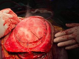 SU-POR-BRAİN SURGERRY 