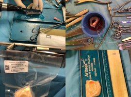 TÜRKİYEDE PROSES EDİLEN İLK MENİSKÜS NAKLİ