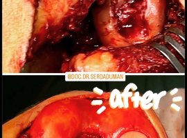 OSTEOCHONDRAL ALLOGREFT